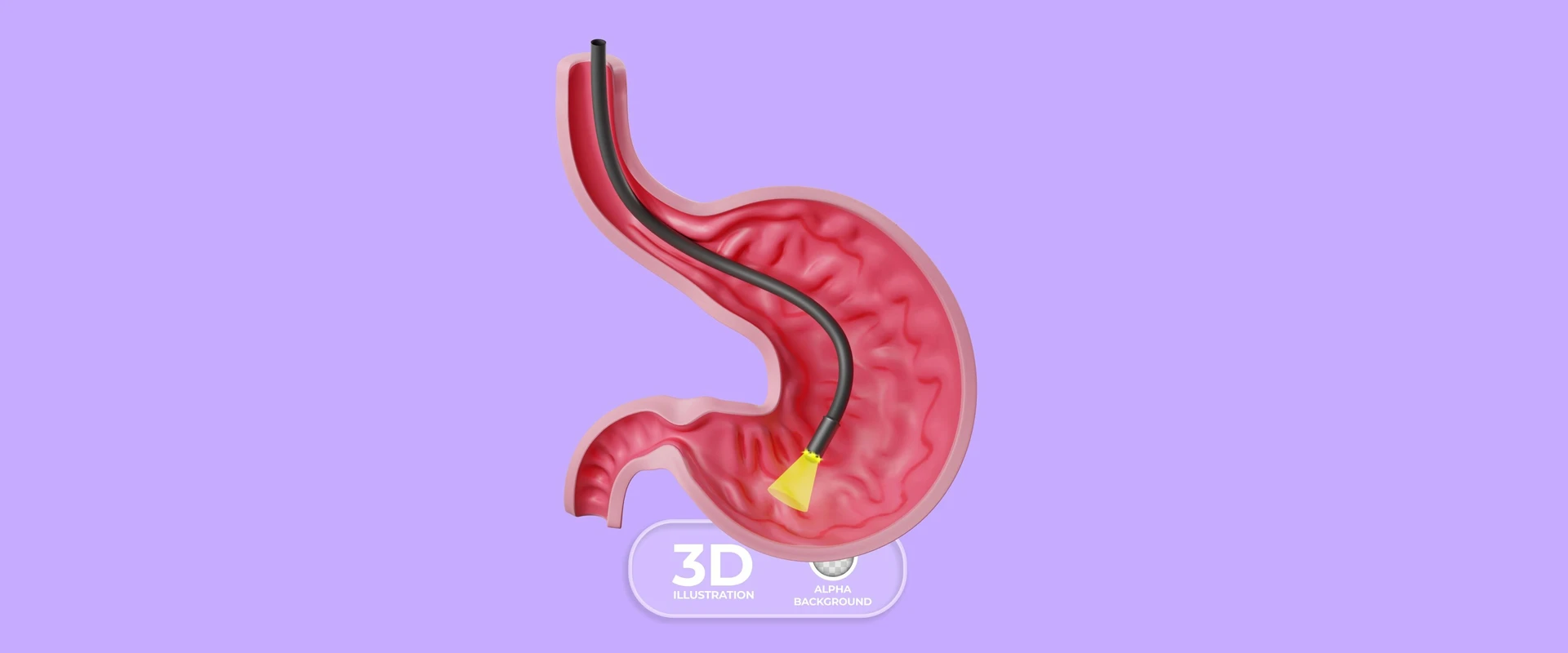 Endoskopik Tüp Mide